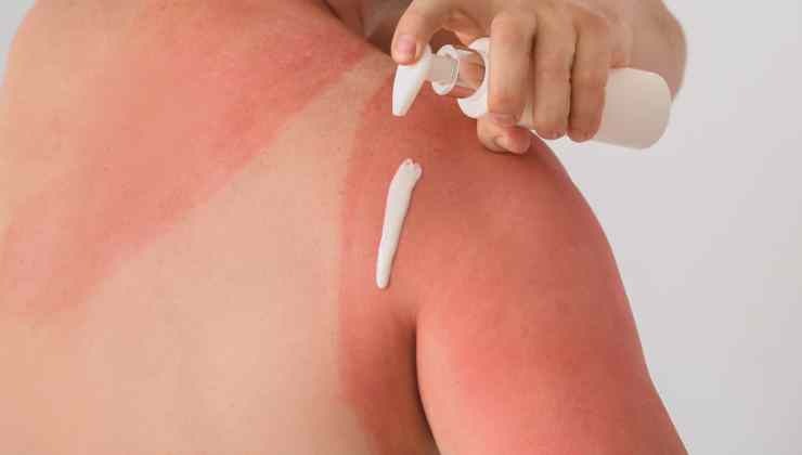 persona che si mette crema sulla pelle bruciata