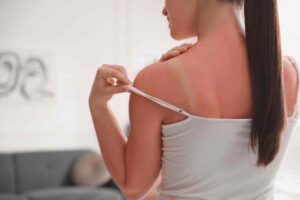 mujer con quemadura de sol
